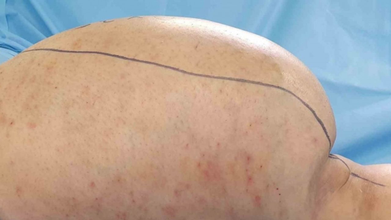 Ameliyatta kesilmekten kurtulan bacağından 6 kilo tümör çıkarıldı