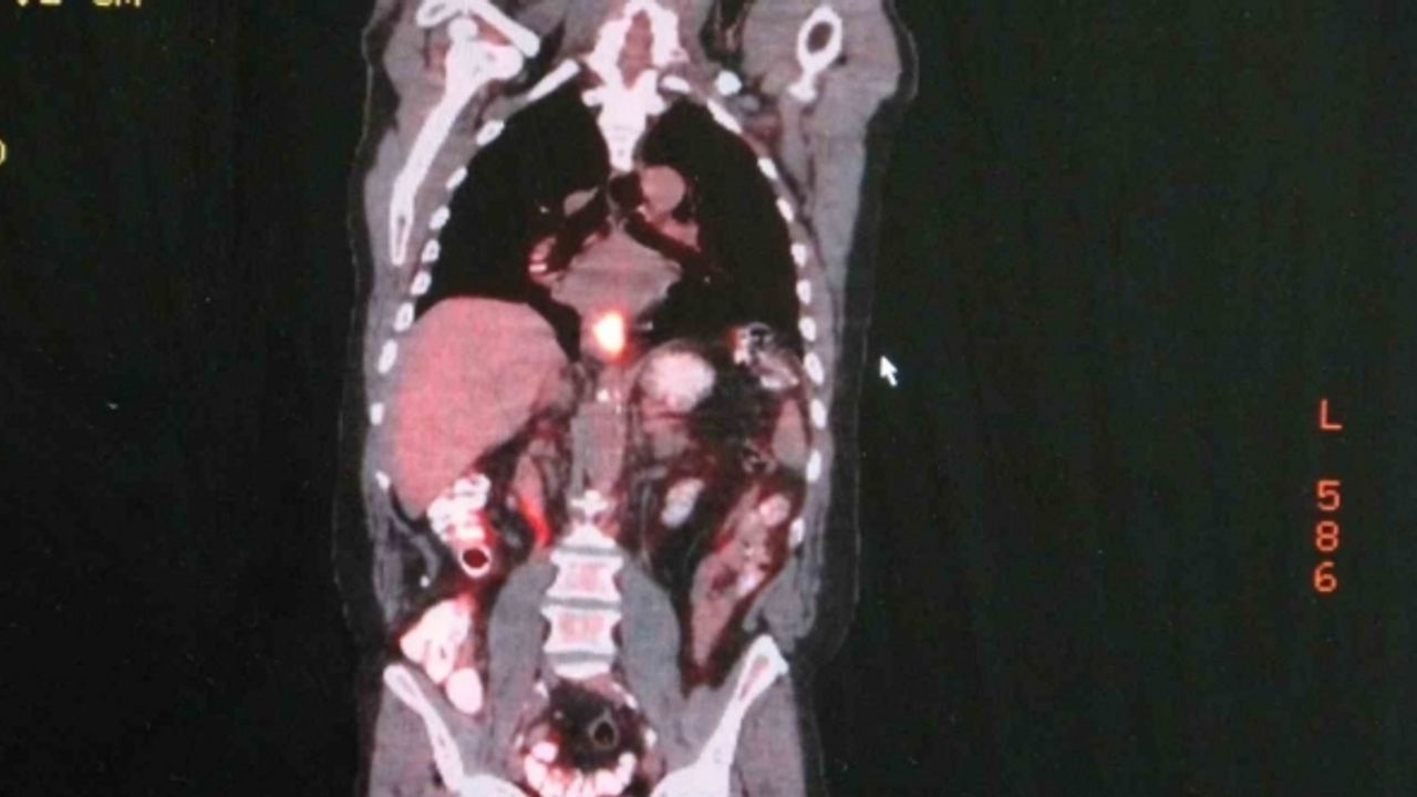 Uzmanından yemek borusu kanseri uyarısı: "Yemek borusu kanseri sinsi bir hastalıktır, erken teşhis tedavi şansını arttırır"