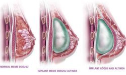 Meme Büyütme Ameliyatı: Doğru Planlama, İdeal Estetik ve Özgüven