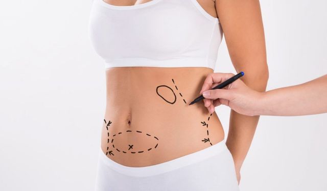Liposuction Hakkında Bilinmesi Gereken Altın Bilgiler