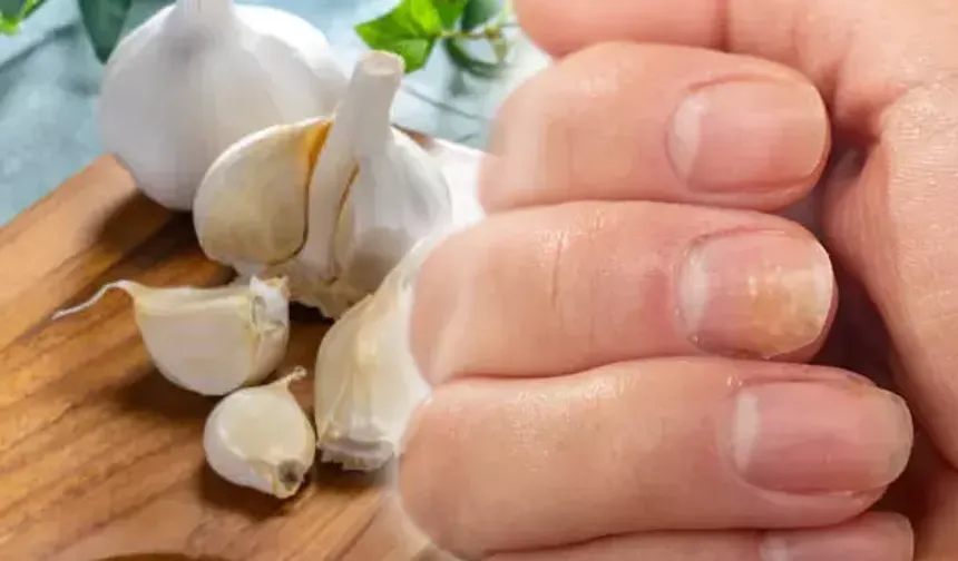 Doğal Mucize: Tırnak Mantarını Kısa Sürede Yok Eden 10 Etkili Yöntem